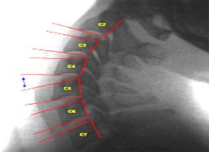 Image - Anterior Widening at C4-C5