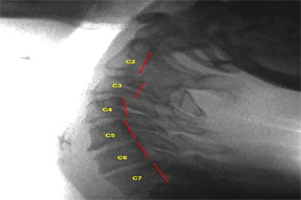 Image - Retrolisthesis of C3-C4 & C4-C5