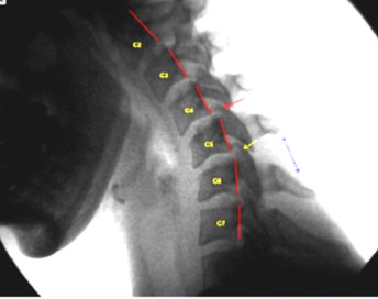 Image - Anterolisthesis of C4 on C5