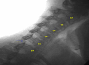 Image - Facet Joint Gapping at C6-C7