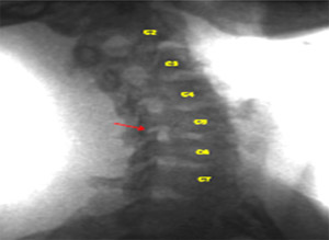 Image - Foramenal Narrowing at C5-C6