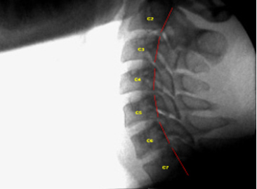 Image - Normal Extension