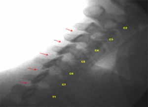Image - Normal Oblique Flexion