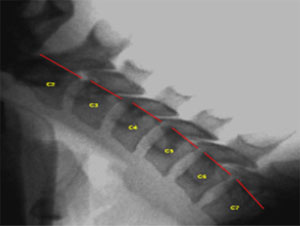 Image - Normal Flexion