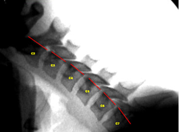 Image - Normal Flexion