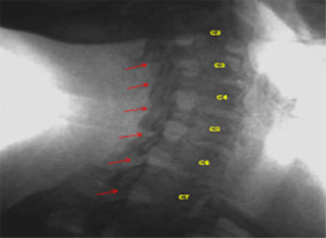 Image - Normal Oblique Extension